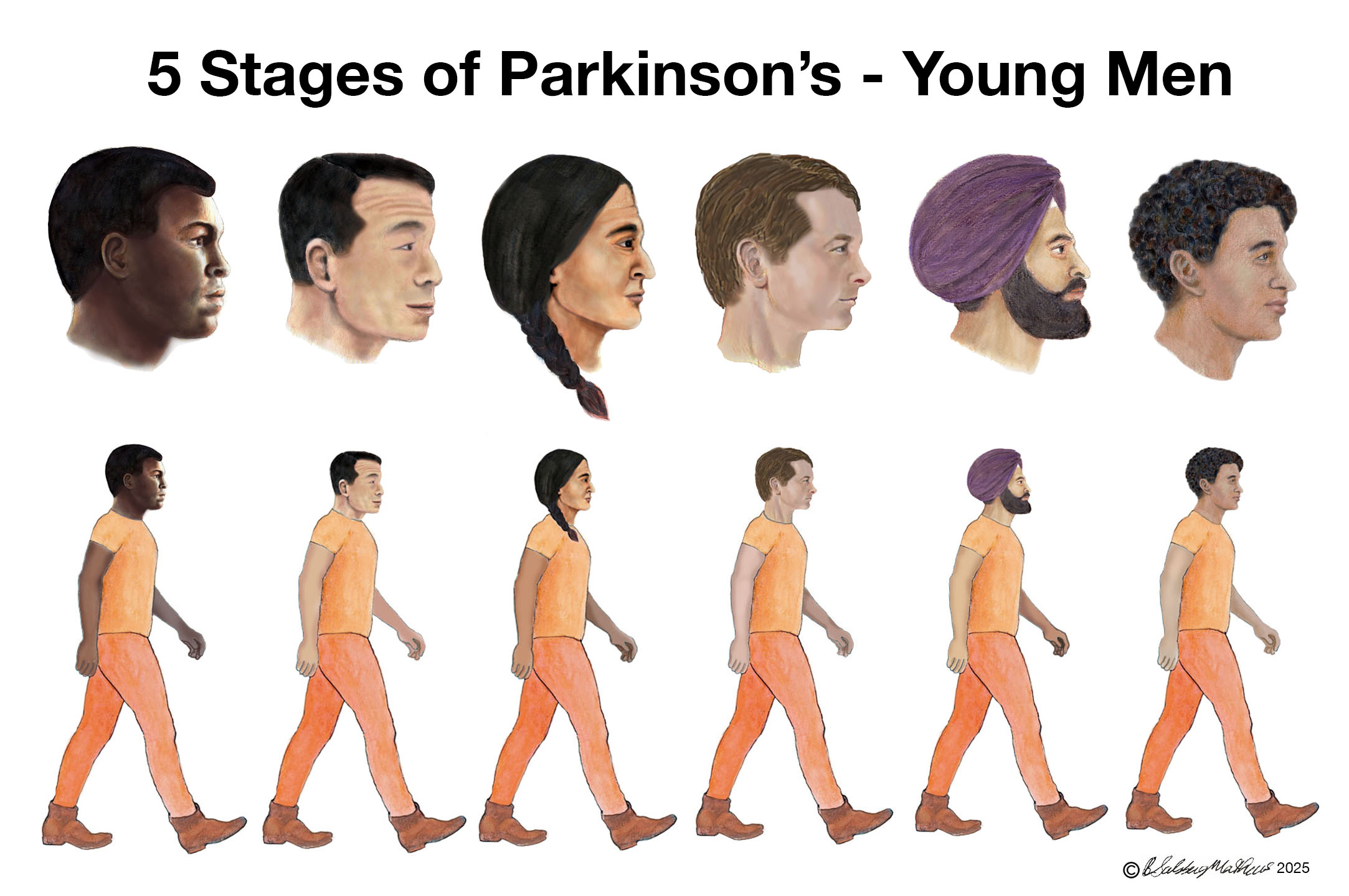 5 Stages of Parkinson's